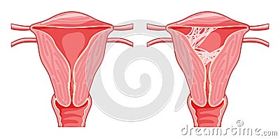 Set of Asherman syndrome Female reproductive system scar tissue adhesions in uterus Front view in a cut. Sick and normal Vector Illustration