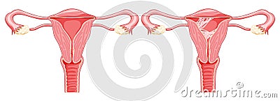 Set of Asherman syndrome Female reproductive system scar tissue adhesions in uterus. Front view in cut. Sick and normal Vector Illustration