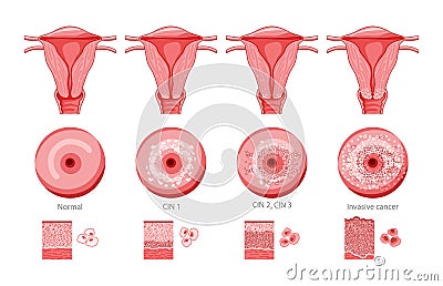 Set of Cervical invasive cancer intraepithelial neoplasia Dysplasia 1 2,3 and normal stage cell morphology on pap smear Vector Illustration