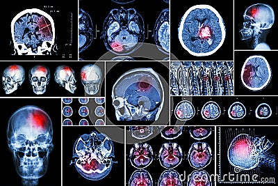 Set , Collection of brain disease ( Cerebral infarction , Hemorrhagic stroke , Brain tumor , Disc herniation with spinal cord comp Stock Photo