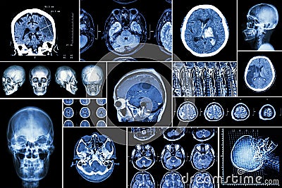 Set , Collection of brain disease ( Cerebral infarction , Hemorrhagic stroke , Brain tumor , Disc herniation with spinal cord comp Stock Photo
