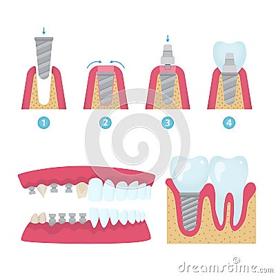 Dental crowns and implantation Vector Illustration