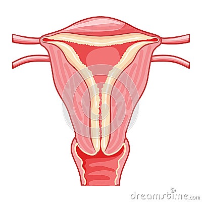 Set of Endometrial hyperplasia Female reproductive system uterus with thick endometrium layer. Front view in a cut Vector Illustration