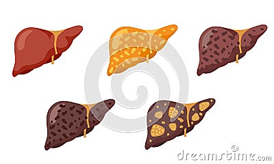 Set of flat vector illustrations on the theme of medicine. Stages of liver diseases. Vector Illustration