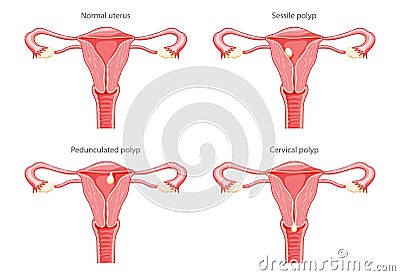 Set of Polyps in the uterus Female reproductive system in cross sections diseases and normal. Front view in a cut. Human Vector Illustration