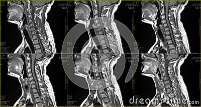 Set of 6 sagittal MRI scans of neck area of caucasian 34 years old male with bilateral paramedial extrusion of the C6-C7 Stock Photo