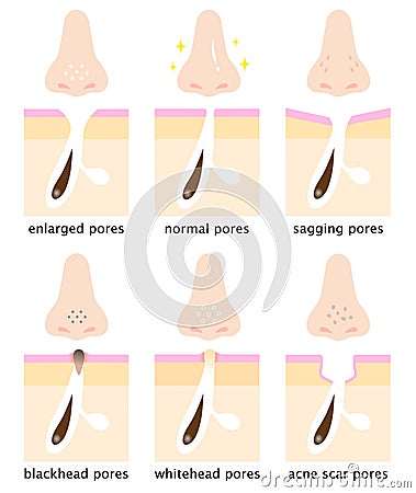 Set of skin pores on human nose and skin diagram. normal, sagging, open, blackhead, whitehead, acne scar. Beauty skin care concept Vector Illustration