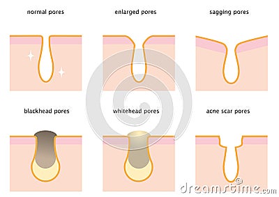 Set of skin pores: normal, sagging, enlarged, blackhead, whitehead and acne scar Vector Illustration