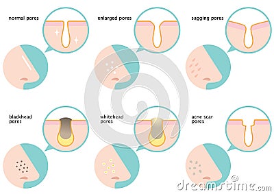 Set of skin pores on nose: normal, sagging, enlarged, blackhead, whitehead and acne scar Vector Illustration