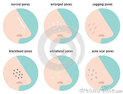 Set of skin pores on nose: normal, sagging, enlarged, blackhead, whitehead and acne scar Vector Illustration