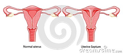 Set of Uterine septum septate uterus normal and with disease Female reproductive system diagram. Front view Vector Illustration