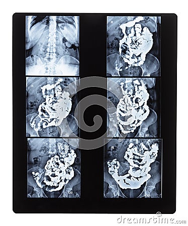 Set of X-ray with Barium studies of small bowel Stock Photo