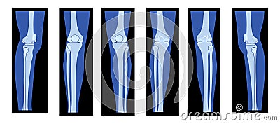 Set of X-Ray Knee femur leg Skeleton Human body - Patella, epicondyle, Tibia, Fibula Bones adult people roentgen front Vector Illustration
