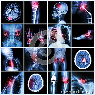 Set of X-ray multiple part of human,Multiple disease,orthopedic,surgery (Stroke,Bone fracture,Orthopedic operationKidney Stock Photo