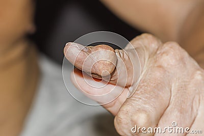 Severe gout in men suffering from joint pain, bone pain, gout, rheumatoid symptoms, radioactive sickness, Stock Photo