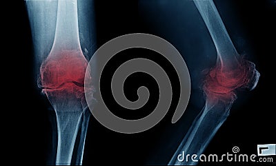 severe OA knee x-ray image on blue color with black background Stock Photo