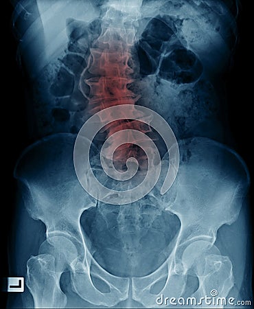 scoliosis lumbar x-ray image Stock Photo