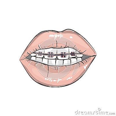 lips braces illustration. Erotic playful hot clipart. Modern smile fashion illustration. Pop art open mouth with teeth and de Vector Illustration