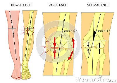 Shapes of the legs.Normal and curved legs.Knock knees.Bowed leg Vector Illustration