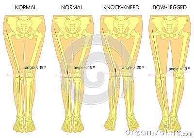 Shapes of the legs. Normal and curved legs. Knock knees. Bowed leg Vector Illustration