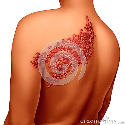 Shingles Disease Cartoon Illustration