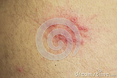 Shingles (herpes zoster) blister skin rash Stock Photo