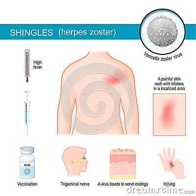 Shingles. infographics about symptoms of herpes zoster Vector Illustration