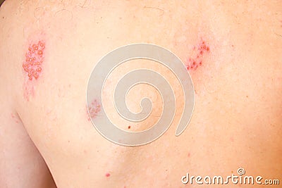 Shingles on men herpes zoster. Closeup. Stock Photo