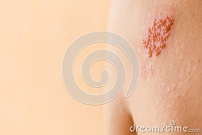 Shingles on men herpes zoster. Closeup. Stock Photo