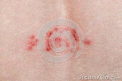 Shingles Skin Disease Stock Photo