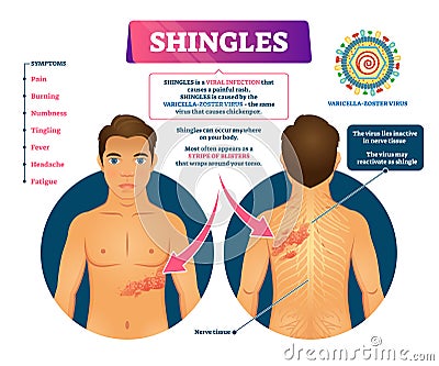 Shingles vector illustration. Labeled medical skin virus explanation scheme Vector Illustration