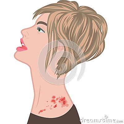 Shingles on a woman shoulder. varicella zoster Vector Illustration