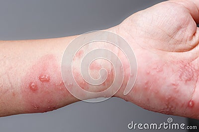 Shingles, Zoster or Herpes Zoster symptoms on arm Stock Photo