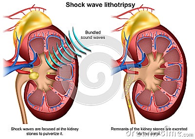 Shock wave lithotripsy 3d medical illustration on white background Vector Illustration