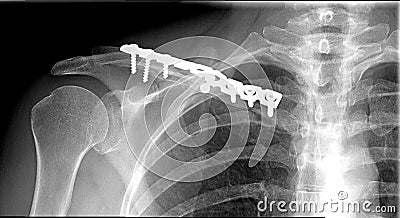 Sholder fraction Clavicle xray Stock Photo