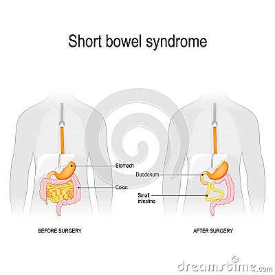 Short gut. Before surgery and after surgery. Vector Illustration