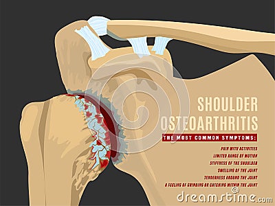 Shoulder arthritis infographic Vector Illustration