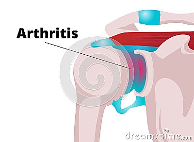 Shoulder arthritis vector illustration Vector Illustration