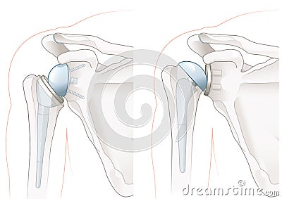 Shoulder arthroplasty. Shoulder replacement. Illustration Stock Photo