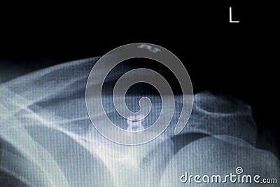 Shoulder back ribs Xray scan Stock Photo