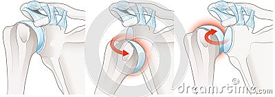 Shoulder dislocation. Anterior dislocation. Posterior dislocation. Labeled Stock Photo