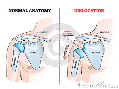 Shoulder dislocation and humerus bone trauma explanation outline diagram Vector Illustration