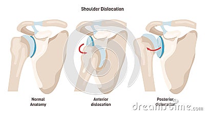 Shoulder dislocation types. Arm injury, upper arm bone pops out of the cup Vector Illustration