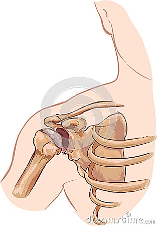 Shoulder dislocation Vector Illustration