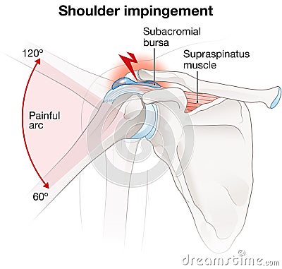 Shoulder impingement, labeled Stock Photo