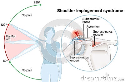 Shoulder impingement. Painful arc. Labeled illustration Stock Photo