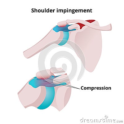 Shoulder impingement vector illustration. Illustration of the muscle tendon and bursa compression Vector Illustration