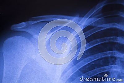 Shoulder joint orthopedic xray scan Stock Photo
