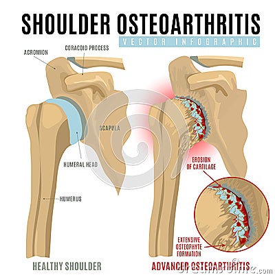 Shoulder osteoarthritis infographic Vector Illustration