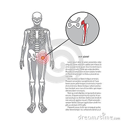 Shoulder prosthesis, vector banner with place for text. Medical illustration Vector Illustration